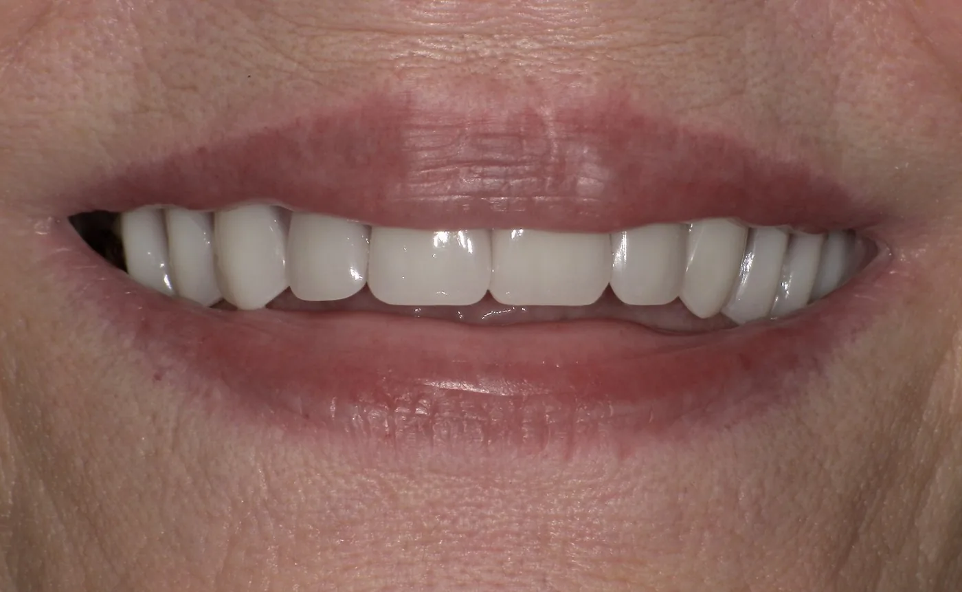 Denture result